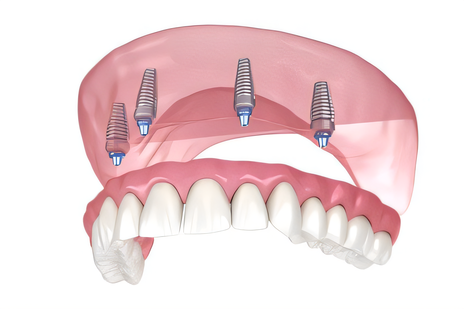 All-on-4 implant yöntemi