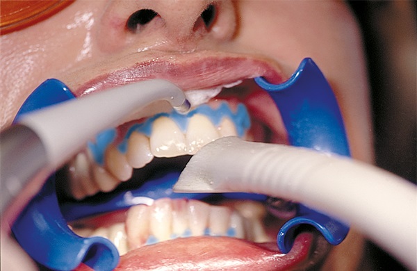 Diş beyazlatma schütz dental