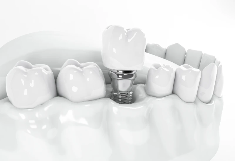 doğru implant seçimi