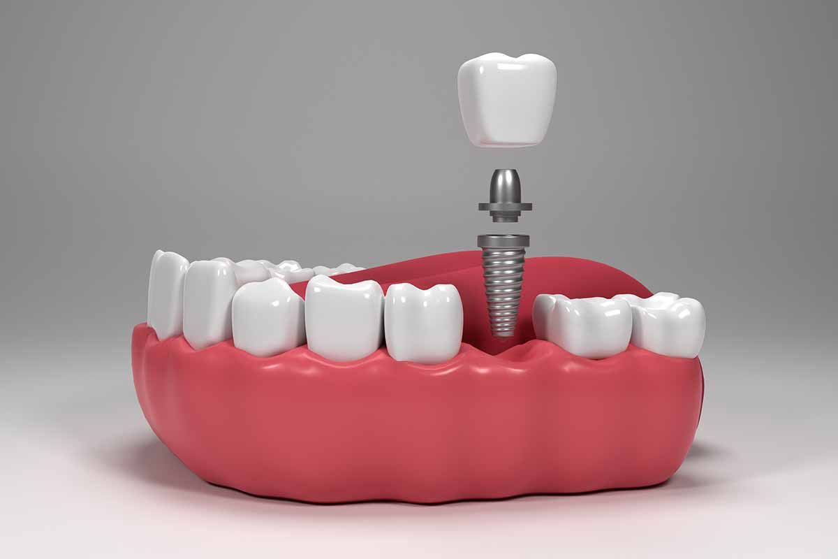Zirkonya implant seçeneği